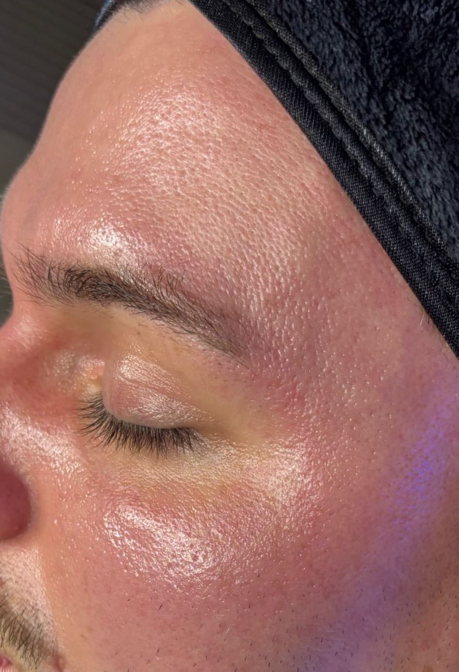 Hydrafacial treatment at SANCTUM