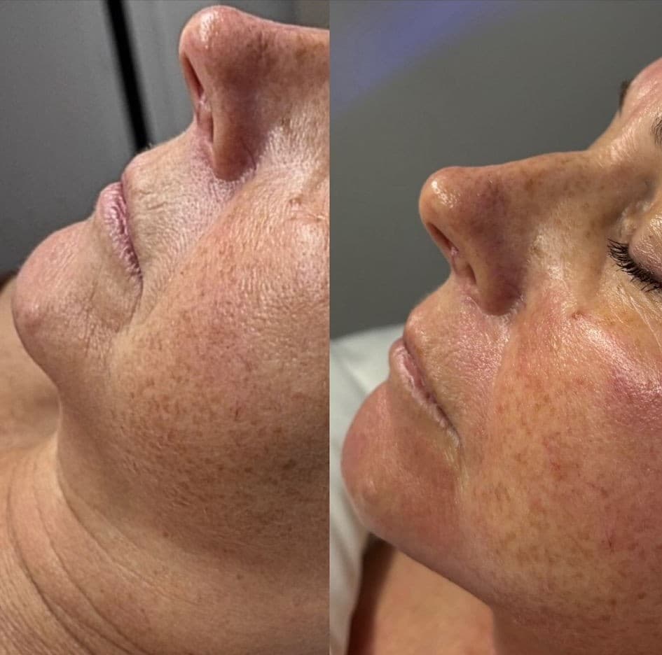 Microneedling treatment at SANCTUM